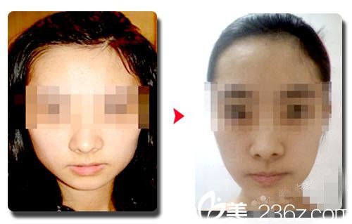 韓國伍人整形醫(yī)院下頜角手術(shù)案例分享