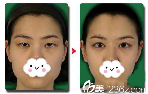 魏成潤院長下頜角手術(shù)案例 魏成潤院長下頜角手術(shù)案例