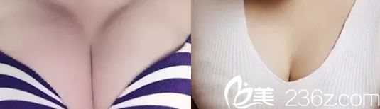 我的美麗蛻變從韓國(guó)娜娜整形醫(yī)院自體脂肪隆胸開(kāi)始 重塑傲人雙峰不是夢(mèng)