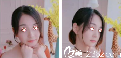 林鐘學(xué)玻尿酸填充下巴加太陽穴術(shù)后半個月