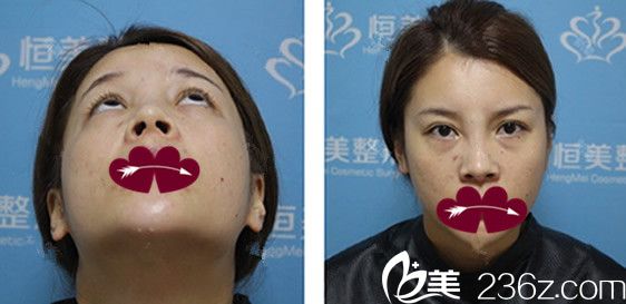 沒有去合肥韓美做隆鼻修復手術+自體脂肪面部填充前照片 沒有去合肥韓美做隆鼻修復手術+自體脂肪面部填充前照片