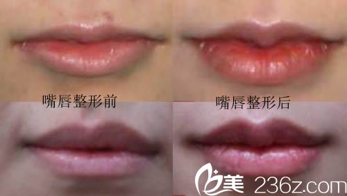 韓國青春整形外科嘟嘟唇案例效果圖 韓國青春整形外科嘟嘟唇案例效果圖