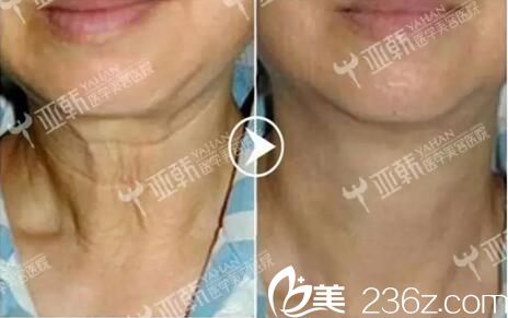 熱瑪吉去除頸紋真人案例效果對比