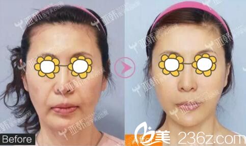 熱瑪吉去除面部皺紋真人案例效果對比