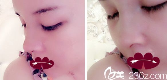 合肥韓美羅定安隆鼻失敗修復+自體脂肪填充全臉術后第3天恢復情況 合肥韓美羅定安隆鼻失敗修復+自體脂肪填充全臉術后第3天恢復情況