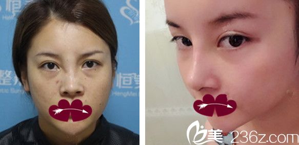 隆鼻失敗修復+面部填充自體脂肪前后對比圖 隆鼻失敗修復+面部填充自體脂肪前后對比圖