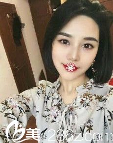 做完雙眼皮+硅膠假體隆鼻我才知道不只新疆華美醫(yī)院靠譜杰也挺靠譜。