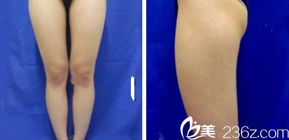 大腿沒有做抽脂前的樣子 大腿沒有做抽脂前的樣子