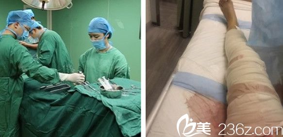 朱德剛給我做大腿吸脂手術(shù)過程中—手術(shù)后即刻照片 朱德剛給我做大腿吸脂手術(shù)過程中—手術(shù)后即刻照片