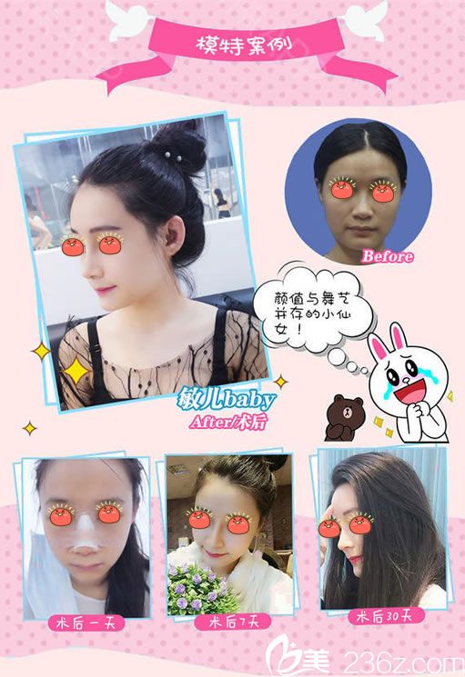 金華玥萊美高順福隆鼻案例 金華玥萊美高順福隆鼻案例