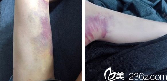 在合肥華美整形做大腿抽脂術(shù)后第10天恢復(fù)情況 在合肥華美整形做大腿抽脂術(shù)后第10天恢復(fù)情況