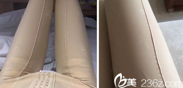 合肥華美整形朱德剛做吸脂瘦大腿第15天照片 合肥華美整形朱德剛做吸脂瘦大腿第15天照片
