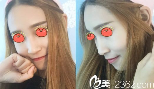 之前注射玻尿酸隆鼻很快吸收了,這次干脆找金華玥萊美高順福做了鼻綜合假體隆鼻