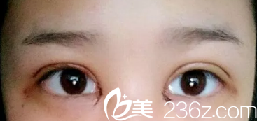 剛做完眼綜合眼睛稍腫