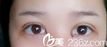 雙眼皮恢復(fù)7天拆線后消腫