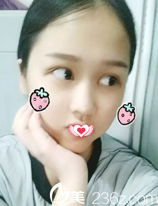 眼綜合12天手術(shù)痕跡消失