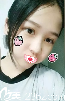 真正的閉眼無痕同時(shí)還自然翹睫的雙眼皮 讓我在邢臺媚思嘉做完眼綜合實(shí)現(xiàn)