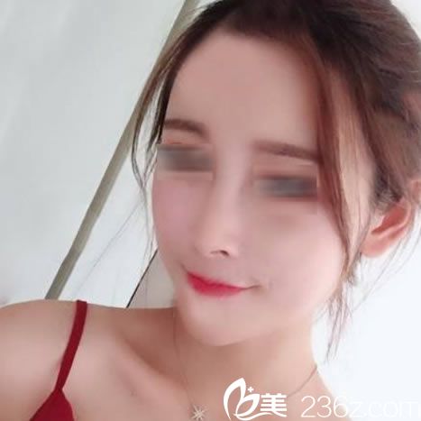 做完自體脂肪填充15天恢復(fù)照