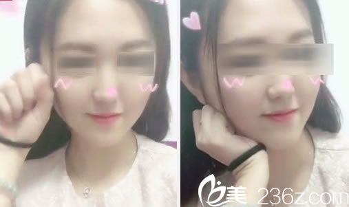 金華玥萊美做脂肪填充30天<span style=