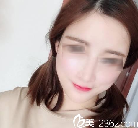 自從知道脂肪填充這個手術(shù)就一直想做,終于來金華玥萊美做了腰腹抽脂和全臉脂肪填充