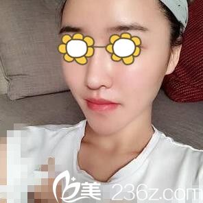 看我在韓國(guó)美&美微整形醫(yī)院注射玻尿酸豐下巴1個(gè)月了，秀秀效果