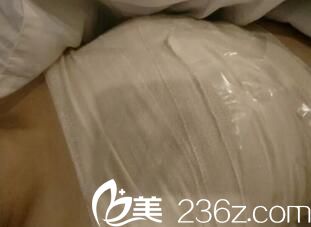 假體隆胸手術(shù)2天