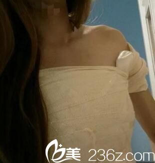 在鄭州集美做假體隆胸術(shù)后3天