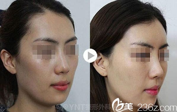 韓國(guó)YNT整形<span style=