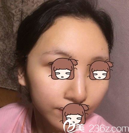 韓國YNT整形醫(yī)院鼻部綜合整形手術(shù)前 韓國YNT整形醫(yī)院鼻部綜合整形手術(shù)前