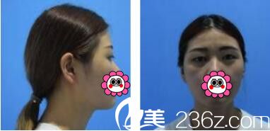 韓國李韓率整形外科李翰率韓式雙眼皮真人案例術(shù)前照 韓國李韓率整形外科李翰率韓式雙眼皮真人案例術(shù)前照