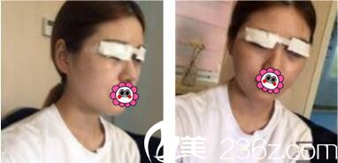 韓國李韓率整形外科李翰率韓式雙眼皮真人案例術(shù)后天 韓國李韓率整形外科李翰率韓式雙眼皮真人案例術(shù)后天