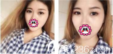 韓國李韓率整形外科李翰率韓式雙眼皮真人案例術(shù)后十五天 韓國李韓率整形外科李翰率韓式雙眼皮真人案例術(shù)后十五天