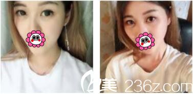 韓國李韓率整形外科李翰率韓式雙眼皮真人案例術(shù)后一個月 韓國李韓率整形外科李翰率韓式雙眼皮真人案例術(shù)后一個月