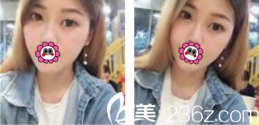 趁著暑期去韓國李韓率做了雙眼皮，擺脫雙眼皮貼