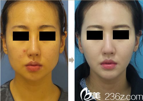 迪美麗魔力V臉吸脂案例對比 迪美麗魔力V臉吸脂案例對比