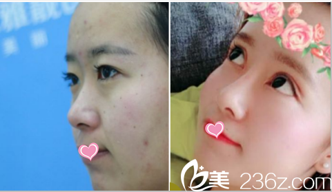 北京雅靚雙眼皮隆鼻案例 北京雅靚雙眼皮隆鼻案例