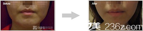 韓國(guó)冬柏美姿韓方美容V-line面部提升術(shù)案例對(duì)比圖 韓國(guó)冬柏美姿韓方美容V-line面部提升術(shù)案例對(duì)比圖