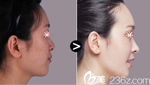 <!--<i data=20240703-sp></i>-->肋骨鼻綜合實例對比圖 <!--<i data=20240703-sp></i>-->肋骨鼻綜合實例對比圖