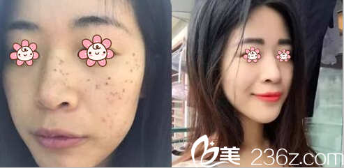 張國寧醫(yī)生激光祛斑案例