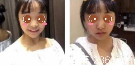 韓國李韓率整形外科李翰率假體隆鼻真人案例術(shù)前照 韓國李韓率整形外科李翰率假體隆鼻真人案例術(shù)前照