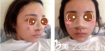 韓國李韓率整形外科李翰率假體隆鼻真人案例術(shù)后第三天 韓國李韓率整形外科李翰率假體隆鼻真人案例術(shù)后第三天