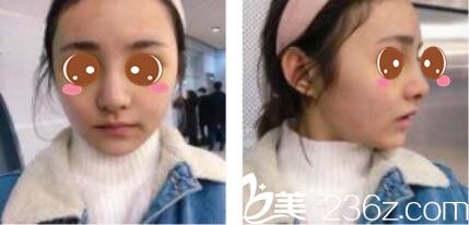 韓國李韓率整形外科李翰率假體隆鼻真人案例術(shù)后第七天 韓國李韓率整形外科李翰率假體隆鼻真人案例術(shù)后第七天