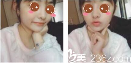 韓國李韓率整形外科李翰率假體隆鼻真人案例術(shù)后 一個月 韓國李韓率整形外科李翰率假體隆鼻真人案例術(shù)后 一個月