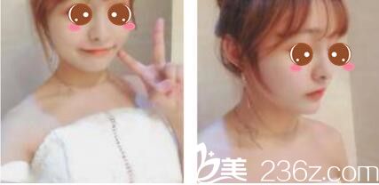 三個(gè)月前預(yù)約的韓國李韓率做假體隆鼻，現(xiàn)在鼻子恢復(fù)的超級自然沒有任何不適感