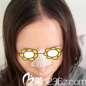 做自體耳軟骨隆鼻第五天