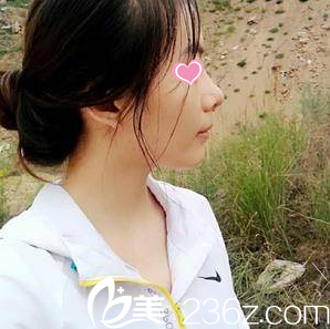 做的鼻整形術(shù)后半個(gè)月