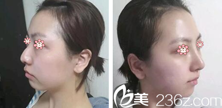 金順珍院長鷹鉤鼻矯正案例 金順珍院長鷹鉤鼻矯正案例