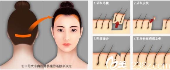 韓國(guó)毛尚毛發(fā)移植醫(yī)院樸正一毛發(fā)移植 韓國(guó)毛尚毛發(fā)移植醫(yī)院樸正一毛發(fā)移植