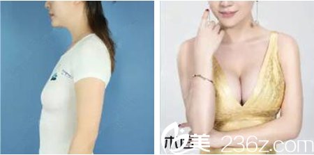 樸真奭院長(zhǎng)假體隆胸案例 樸真奭院長(zhǎng)假體隆胸案例