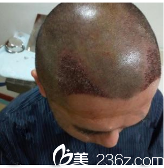 剛找廣州壹加壹游鳳軍做完發(fā)際線種植的效果 剛找廣州壹加壹游鳳軍做完發(fā)際線種植的效果